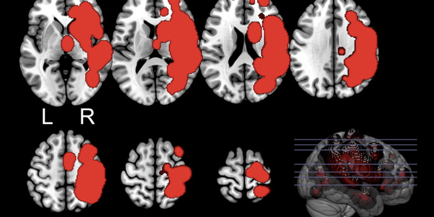 Somatoparaphrénie : affirmer que sa main gauche paralysée n’est pas la sienne mais celle d’une autre personne