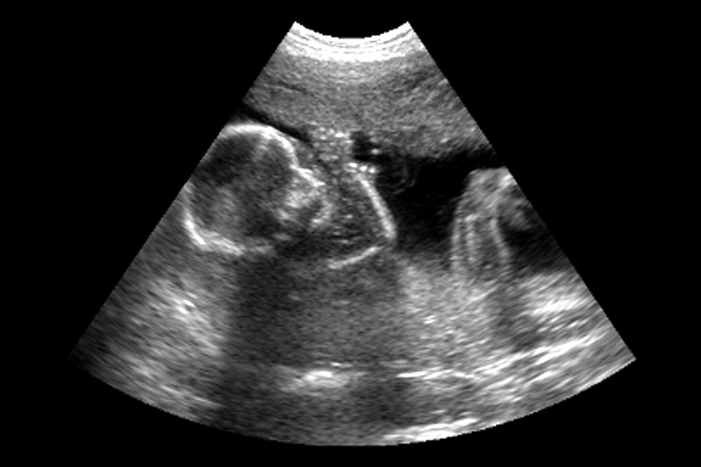 Droitier ou gaucherÂ ? Â«Â Pour comprendre lâ€™origine de la latÃ©ralitÃ©, il faut...