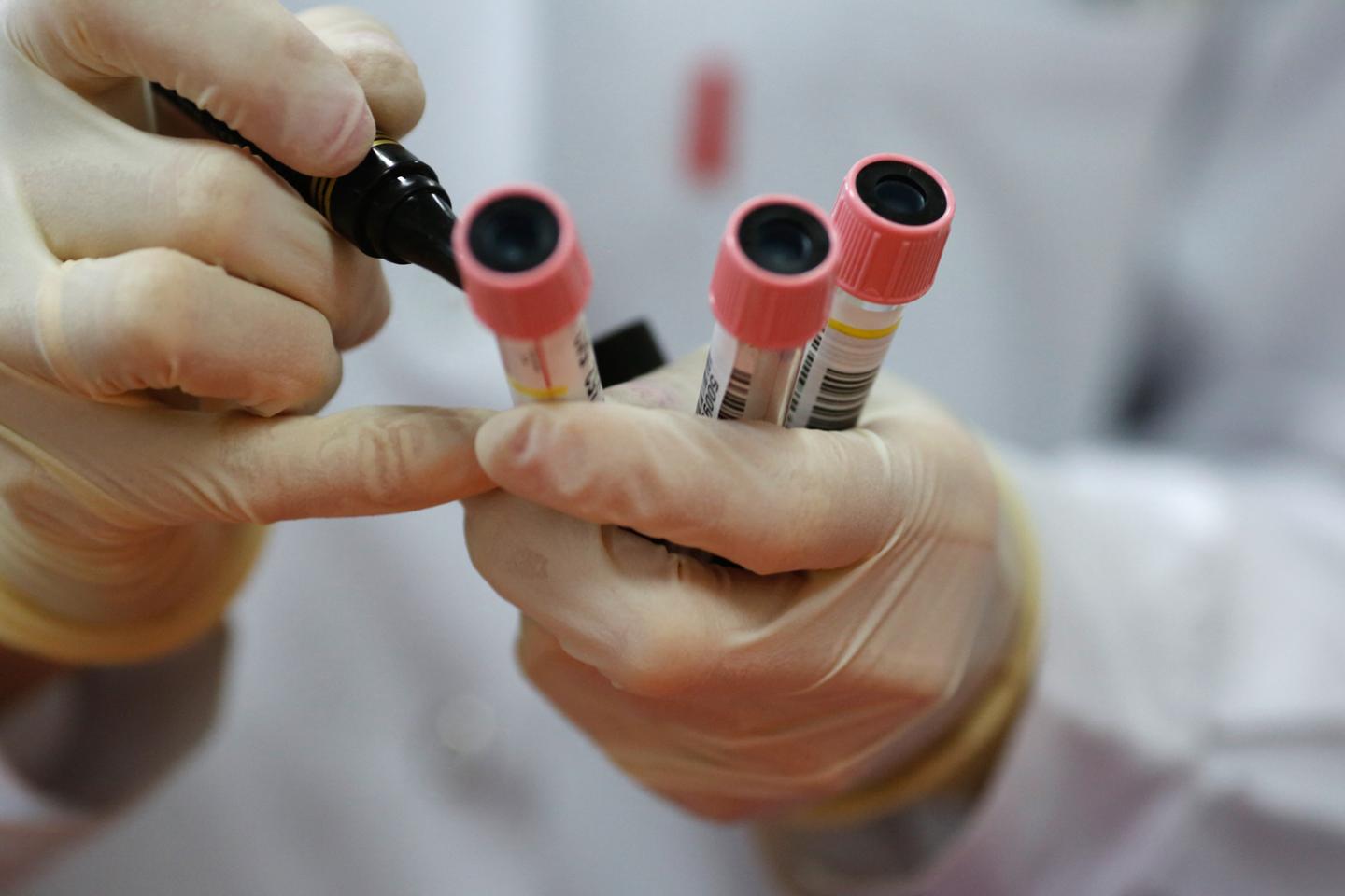 La vitesse de sédimentation, un examen obsolète à abandonner