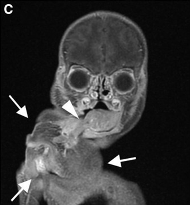 IRM. Présence d’un fœtus in fœtu épignathe (flèches blanches) au bord latéral droit de la langue (pointe du triangle blanc).