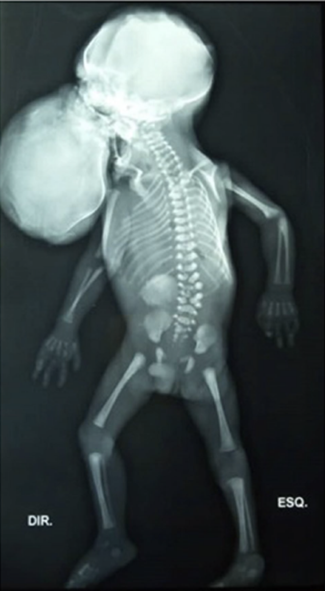 Radiographie du nourrisson mort-né. Une deuxième tête appartenant au fœtus parasite sort de la cavité buccale du fœtus hôte. Le sacrum est absent. Ce cliché correspond au cas exceptionnel relaté à la fin de ce billet.