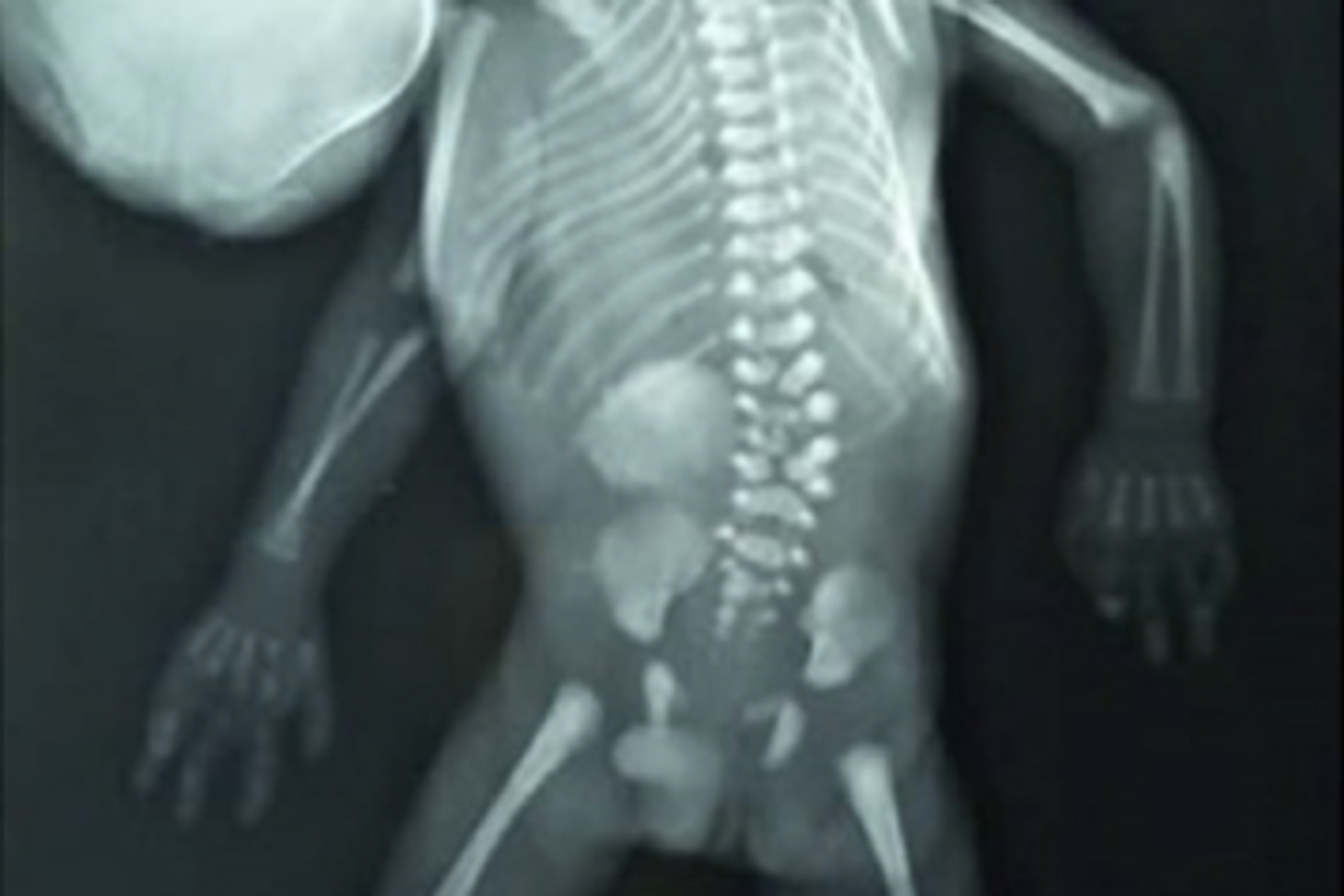 quand un fœtus parasite émerge de la bouche de son jumeau