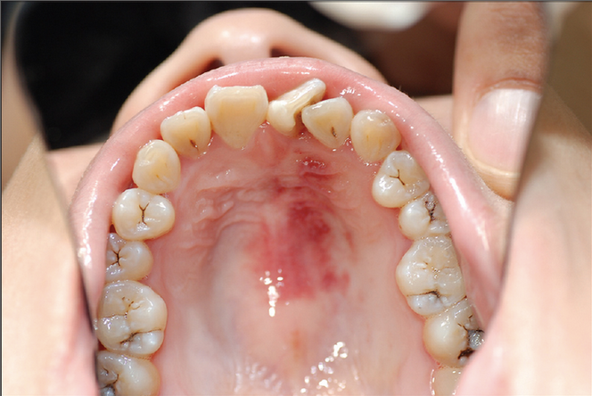 Ecchymose du palais dur.