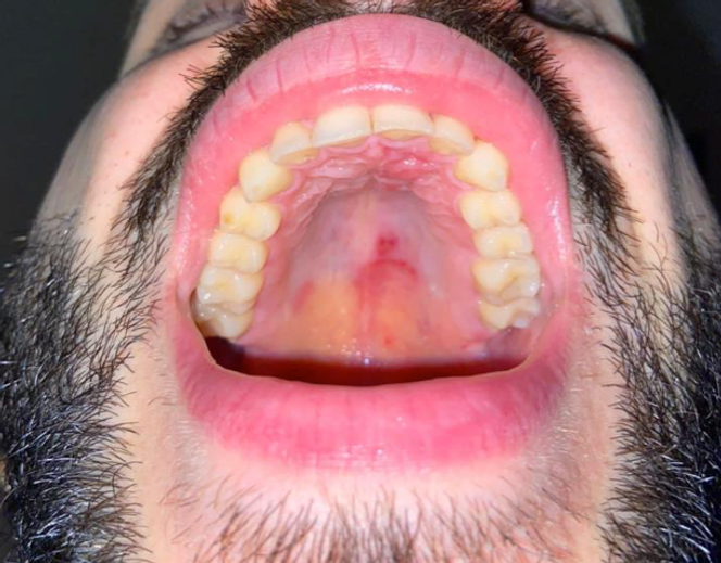 Lésions pétéchiales et ecchymotiques du palais dur après fellation. 