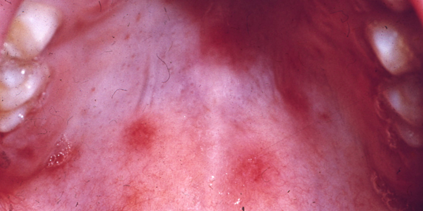 Lésions buccales : quand une fellation ou un cunnilingus conduit chez le dermatologue ou le dentiste