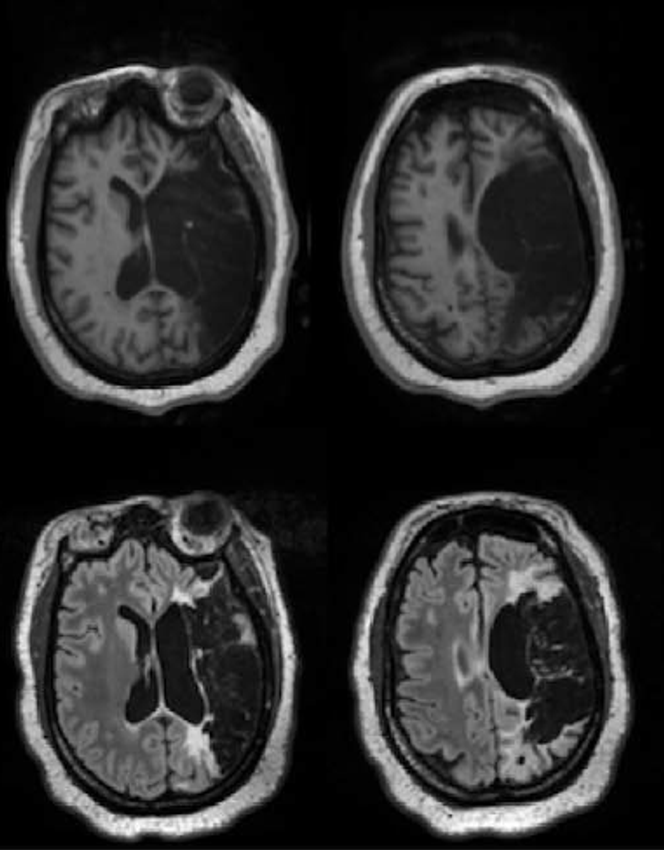 Clichés de l’IRM cérébrale réalisée 61 mois après un AVC massif de l' hémisphère gauche.