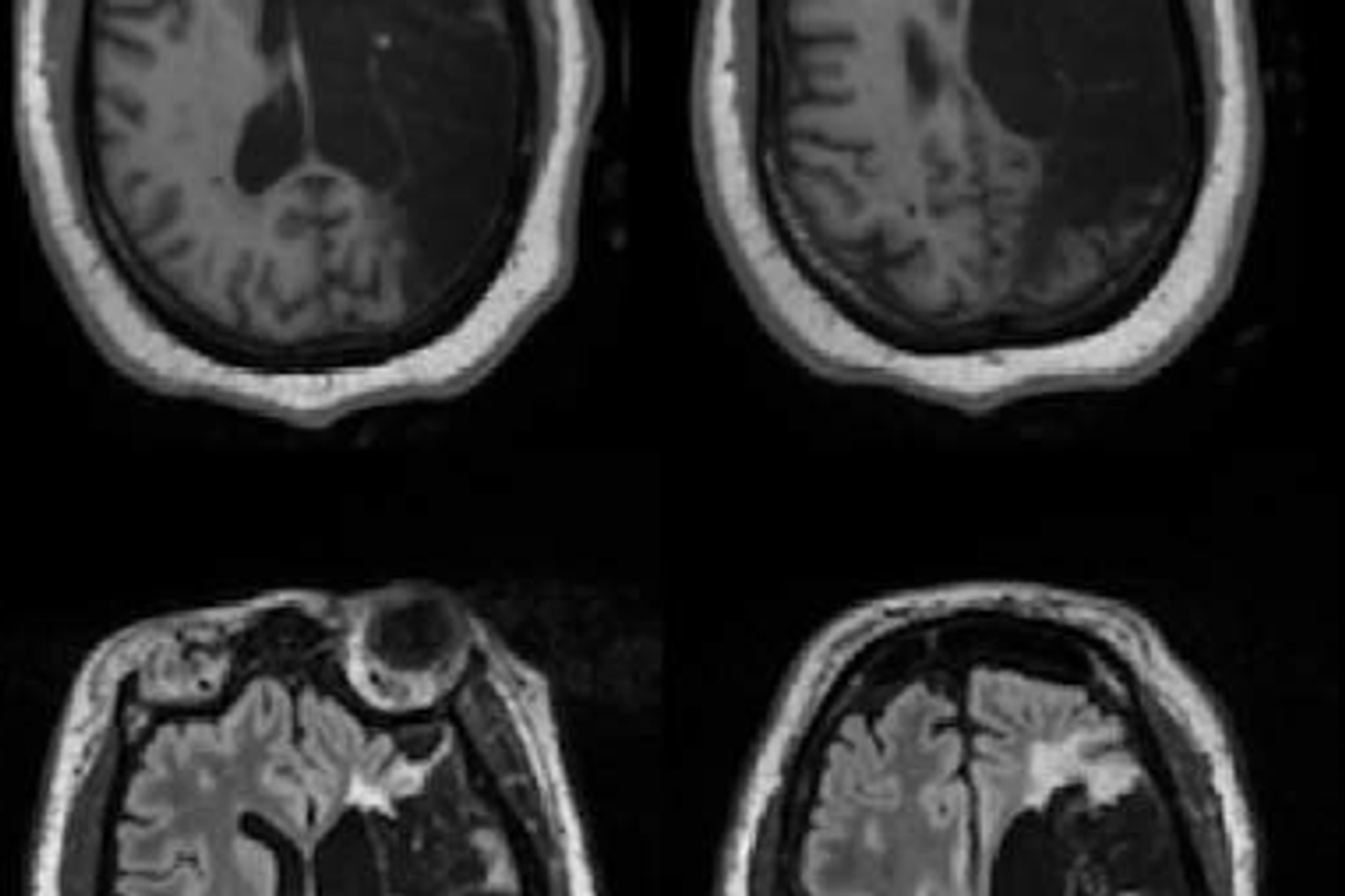 Un AVC dévastateur du cerveau gauche… et pourtant, elle conserve un langage intact Un AVC dévastateur du cerveau gauche… et pourtant, elle conserve un langage intact