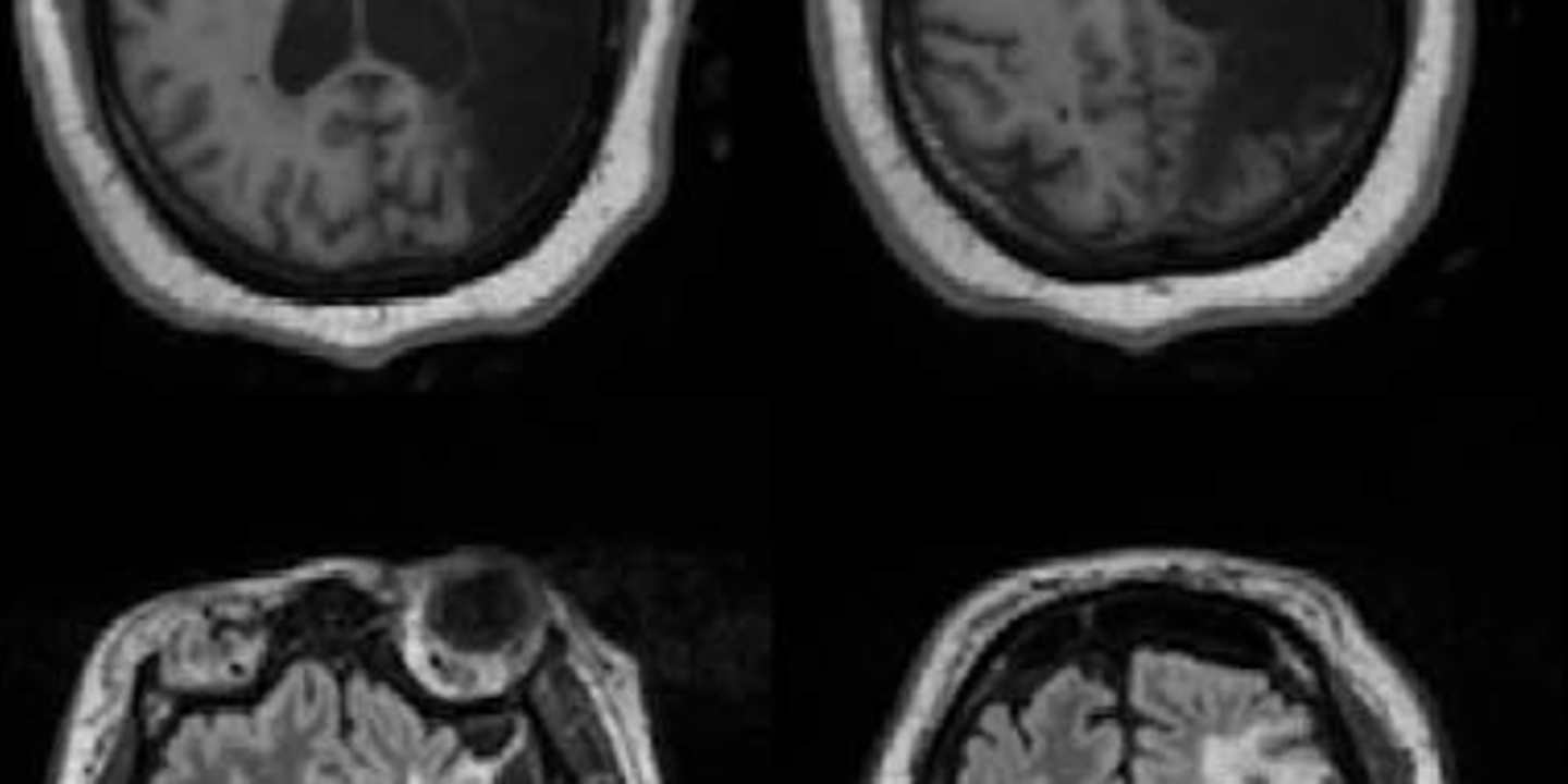 Un AVC dévastateur du cerveau gauche… et pourtant, elle conserve un langage intact