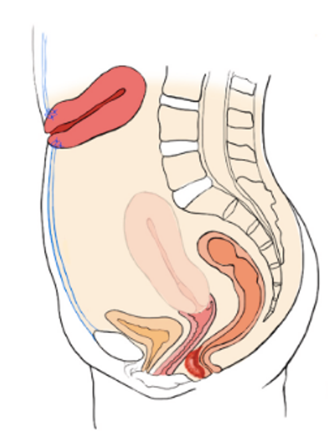 La transposition utérine consiste à déplacer temporairement l’utérus hors du champ d’irradiation en le repositionnant dans la partie supérieure de l’abdomen. Le col utérin est alors fixé à la paroi abdominale, près du nombril.