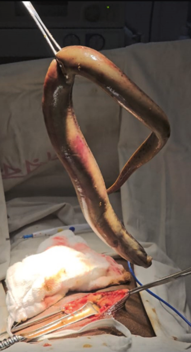 Anguille retirée de la cavité péritonéale du patient. 