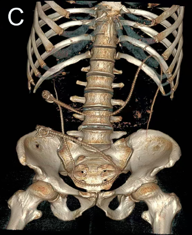 Scanner. Image de reconstruction 3D montrant deux structures squelettiques tubulaires allongées dans le
côlon, compatible avec la présence d'anguilles vivantes.
