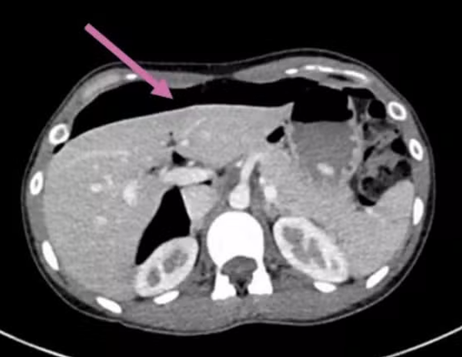 Image obtenue par scanner d’un pneumopéritoine, l’air (en noir) étant indiqué par la flèche rose.