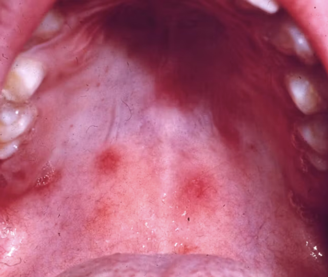 Lésions punctiformes (pétéchies) du palais après fellation.