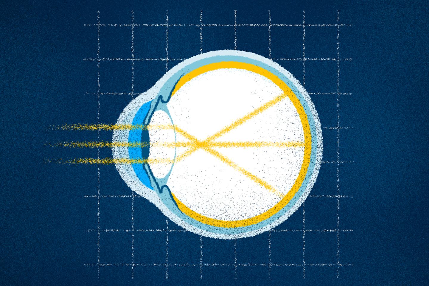 Pourquoi y a-t-il de plus en plus de myopes dans le monde ? Comprendre en trois minutes