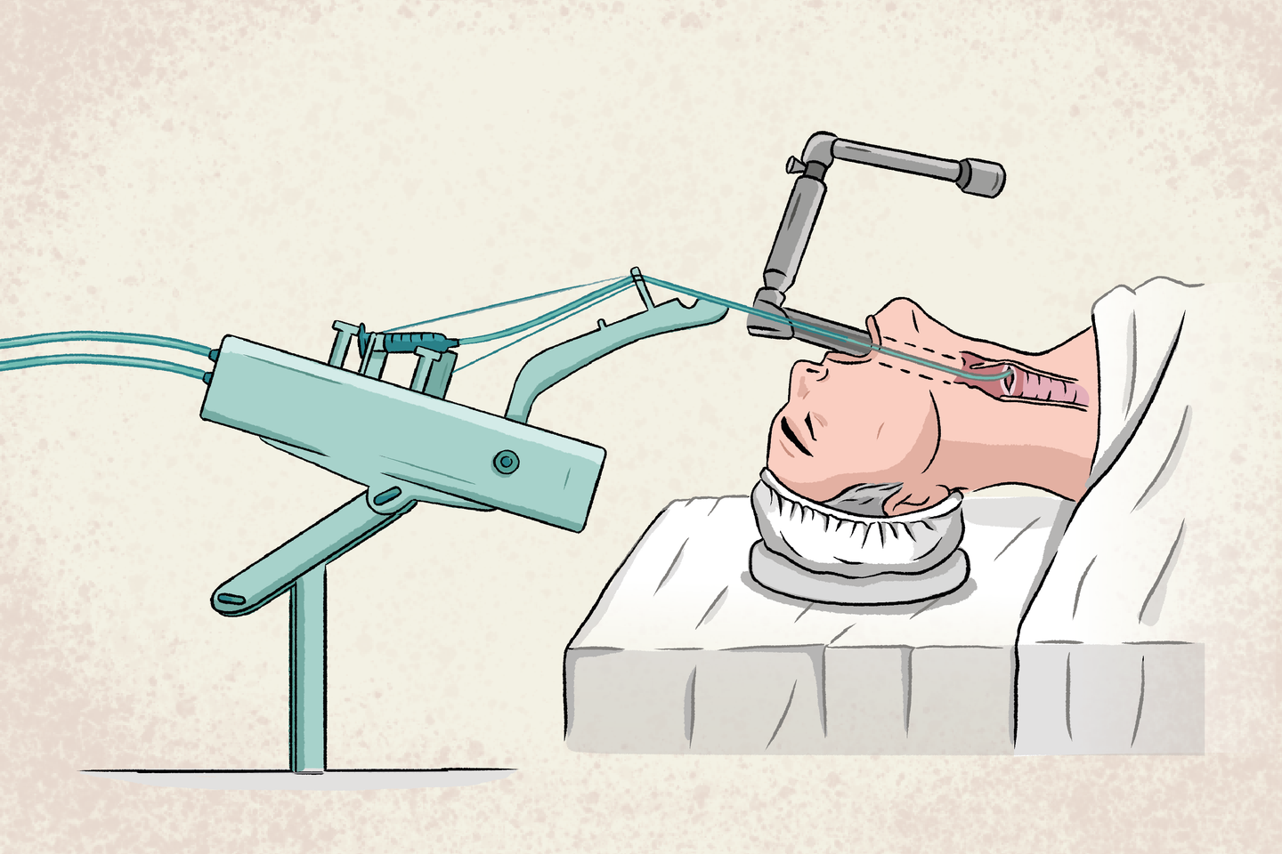 Une imprimante 3D pour réparer les cordes vocales