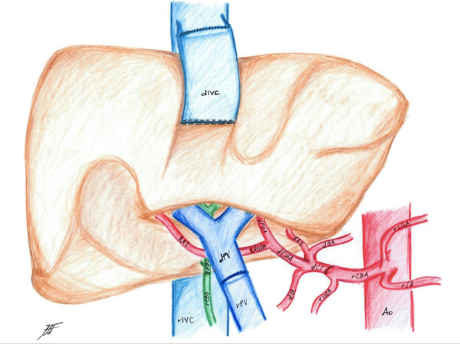 Représentation schématique de la technique d’implantation « retroversus » : rotation du foie à 180 ° selon l’axe crânio-caudal. En haut en bleu : veine cave inférieure du donneur (dIVC). En bas en bleu : veine portale du receveur (rPV), veine portale du donneur (dPV). En rouge : Ao : aorte.