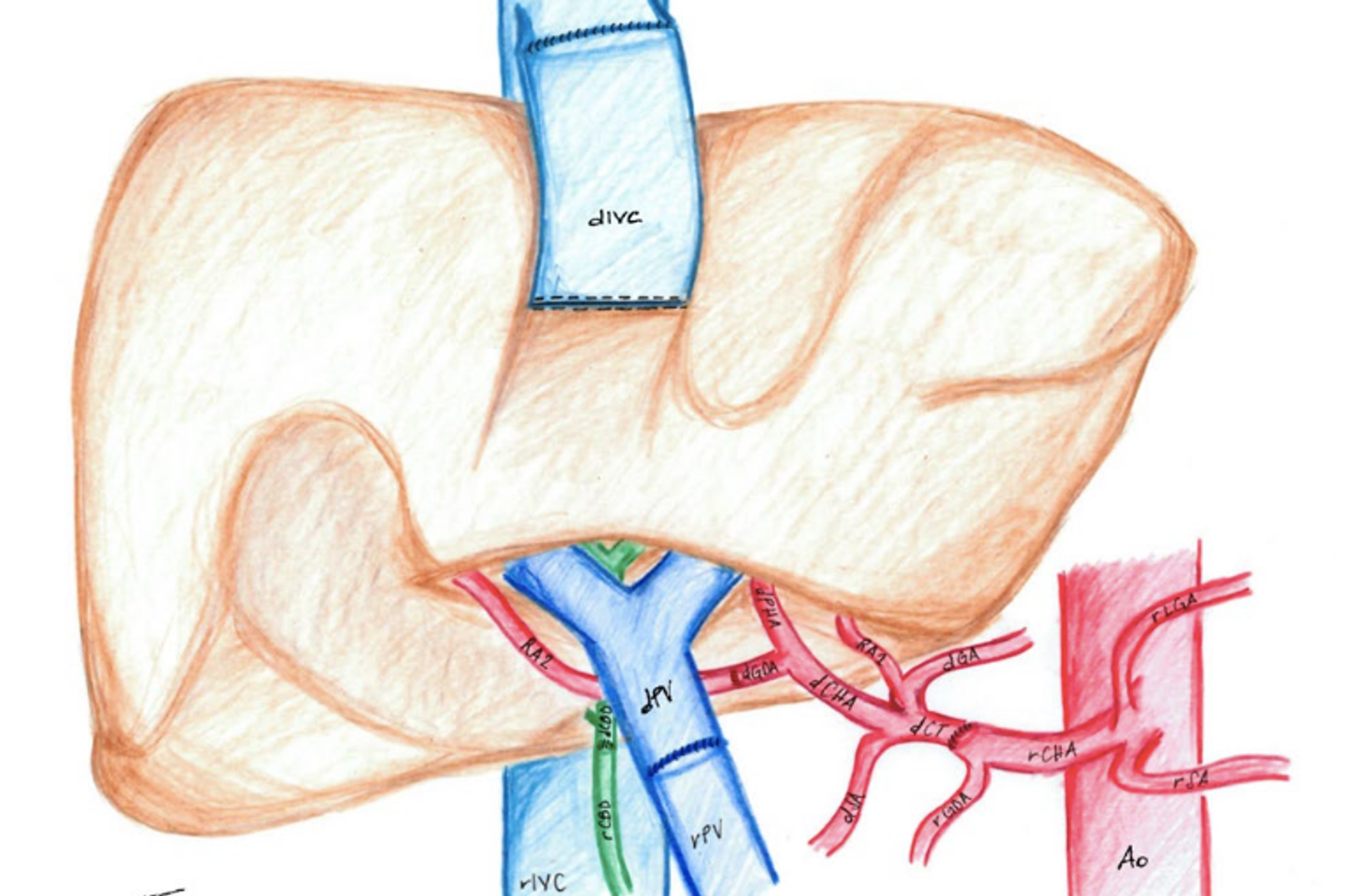 Transplanter à l’envers le foie d’un donneur aux organes en miroir
