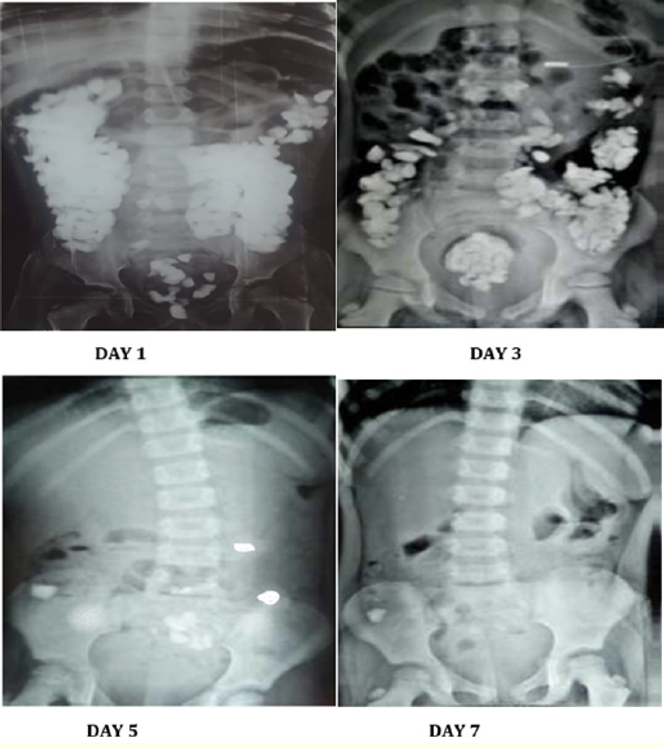 Radiographies de l’abdomen de J1&nbsp;à J7&nbsp;: expulsion progressive des corps étrangers
radio-opaques.