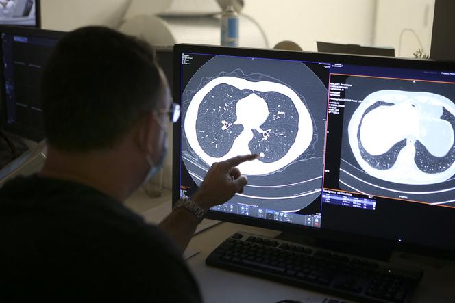 Un radiologue montre un nodule sur un scanner pulmonaire d’un fumeur à Ajaccio (Corse-du-Sud), le 16 décembre 2021.