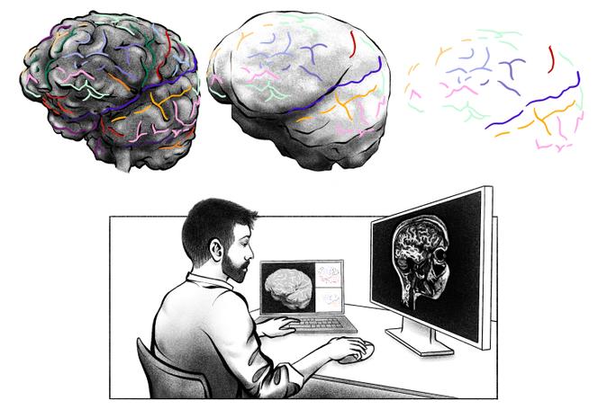 Des données d’imagerie de 75 volontaires ont été utilisées pour déterminer les sillons sur le cerveau puis lire sur la surface interne du crâne, l’endocrâne, les empreintes réellement liées aux sillons visibles sur le cerveau correspondant.