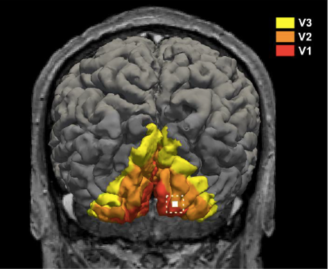 Reconstruction 3D du cortex cérébral du patient avec indication du site d’implantation, à la jonction entre les aires visuelles V1&nbsp;et V2. 