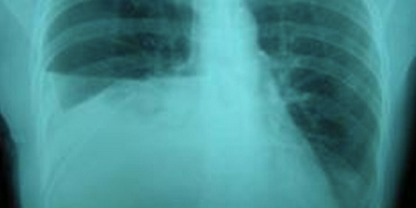 Urinothorax : quand l'urine migre dans la plèvre, une complication rarissime