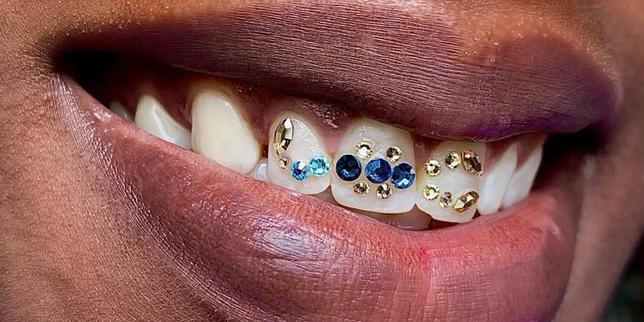 Les « gems », des strass dentaires pour des sourires clinquants
