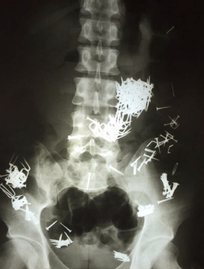 Radiographie abdominale révélant la présence de nombreux clous et vis disséminés dans le tube digestif. Certains objets sont moulés à la forme de l’estomac pour former un gros bézoard, tandis que d’autres sont agglomérés dans le côlon.