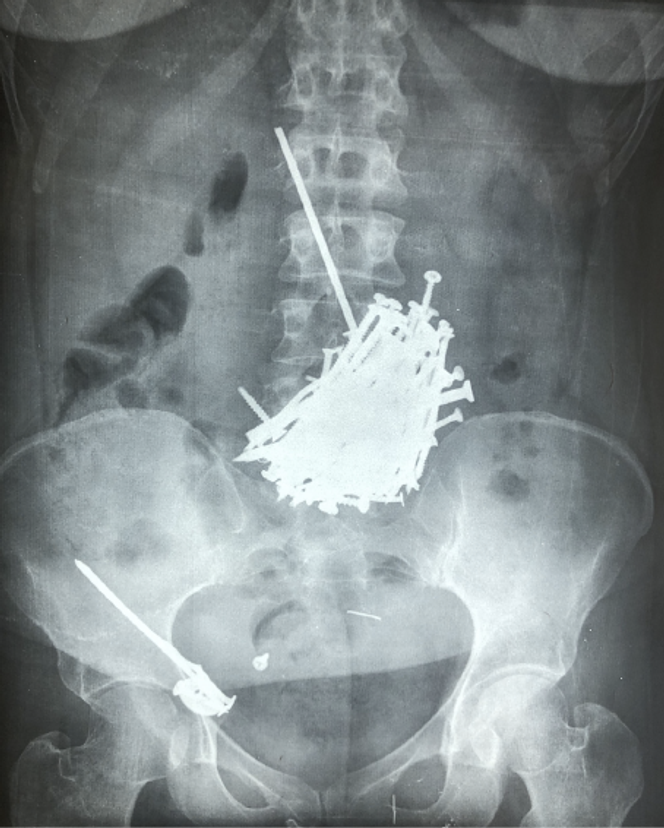 Radiographie abdominale montrant la présence de nombreux clous métalliques dans l’estomac et l’iléon terminal, toute dernière partie de l’intestin grêle.