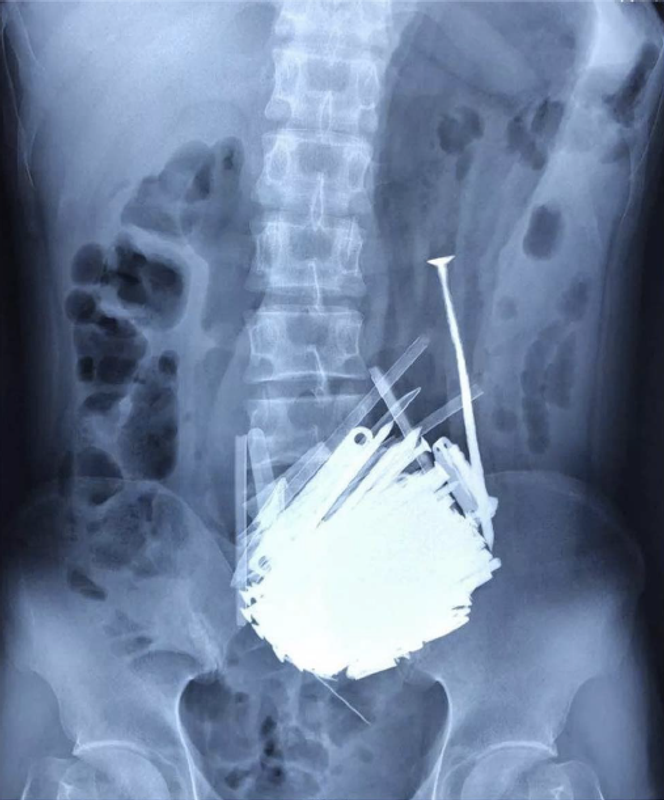 Multiples clous métalliques dans l’estomac à la radiographie abdominale.