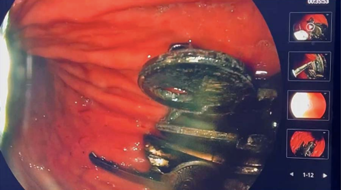 L’endoscopie a mis en évidence la présence de multiples clés logées dans la muqueuse gastrique et de légères ulcérations au niveau du cardia et du corps de l’estomac.