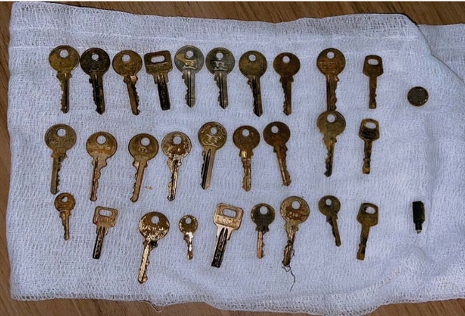 Plusieurs corps étrangers métalliques (clés et petits objets métalliques) sont disposés sur une compresse après leur extraction endoscopique de l’estomac.