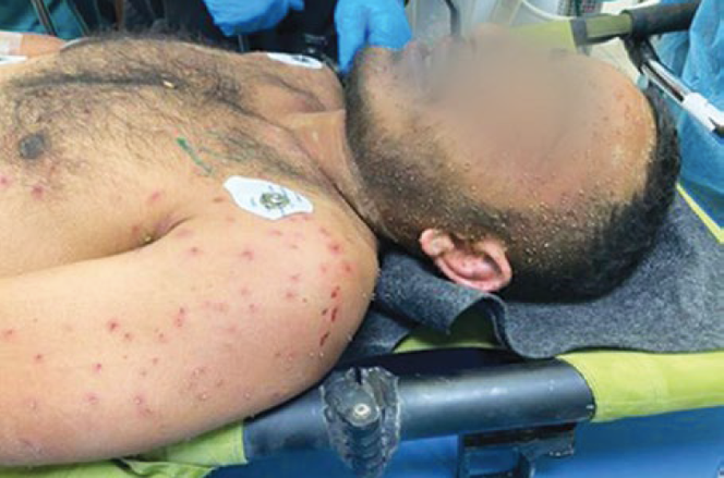 Le patient A présente plus de 300 piqûres d’abeilles, principalement concentrées sur le torse.