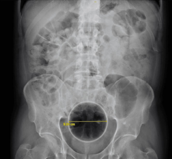 Radiographie. Balle coincée dans le rectum.