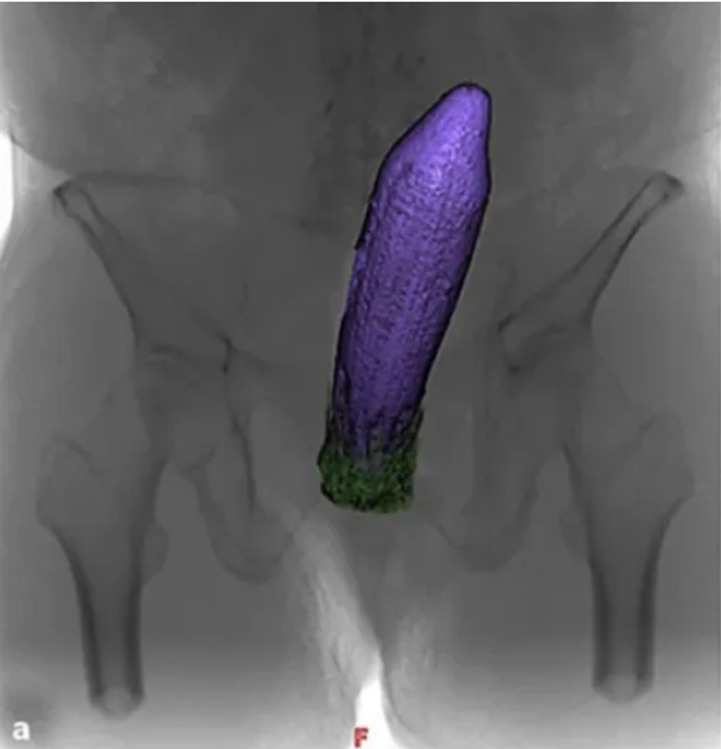 Incarcération dans le rectum d’une aubergine  de 20 cm de long (colorisée en violet). Le calice est en vert. 
