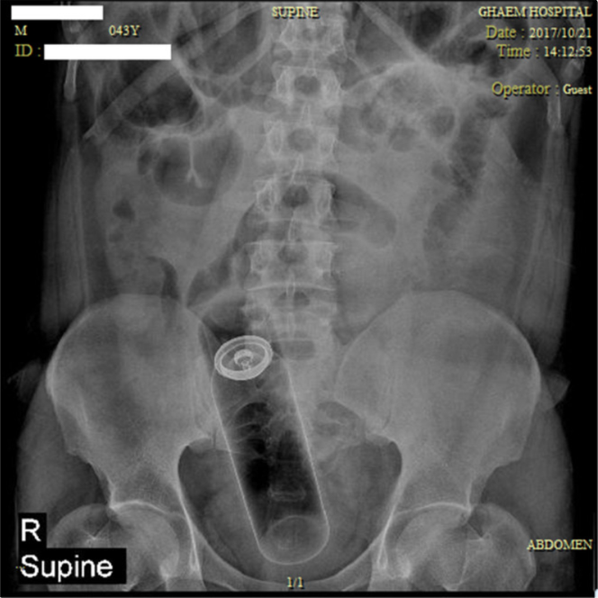 Radiographie. Grande cannette logée dans le rectum.