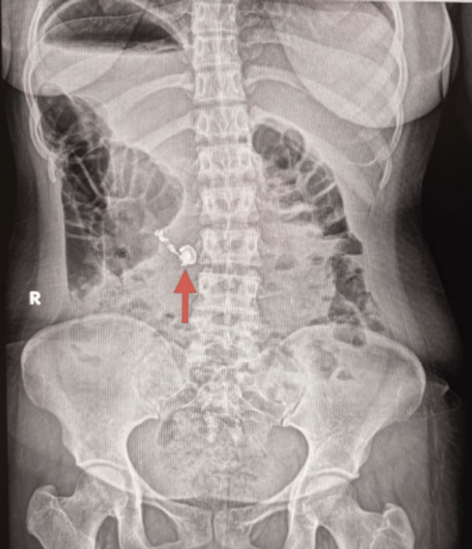 Radiographie abdominale. Présence d’un écouteur sans fil dans le tube digestif.