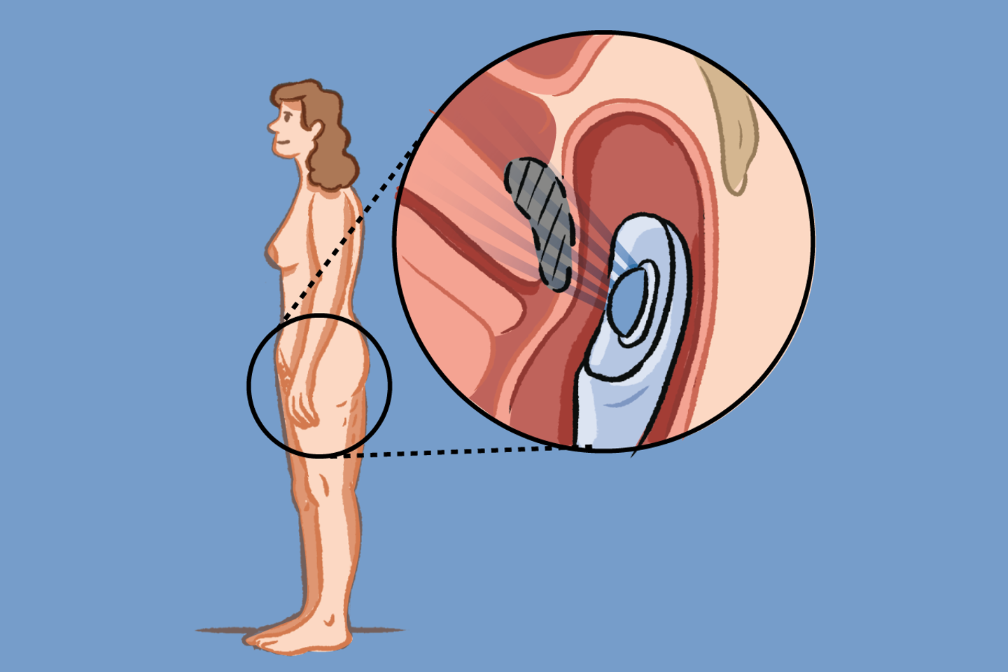 Endométriose digestive : une innovation promet d’éviter la chirurgie grâce aux ultrasons