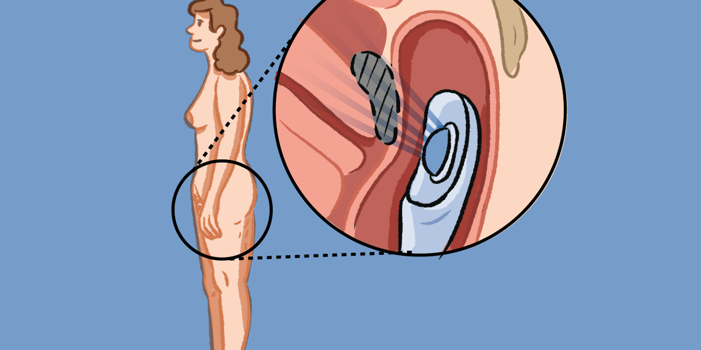 Endométriose digestive : les ultrasons évitent la chirurgie