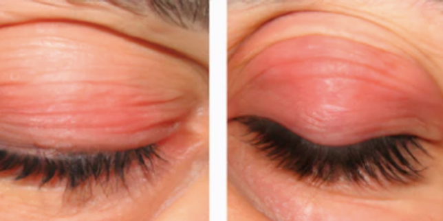 The Ghost in the Archive: How a Fictional Disease Infiltrated Medical Literature