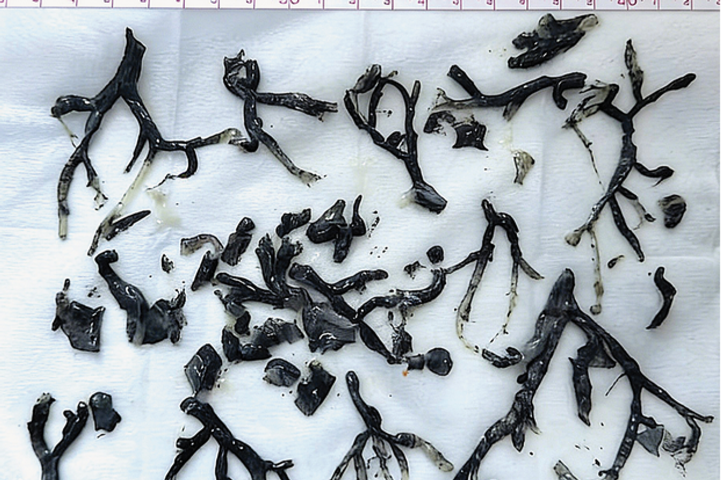 Il inhale la fumée d’un incendie de forêt : des moulages bronchiques de suie impressionnants