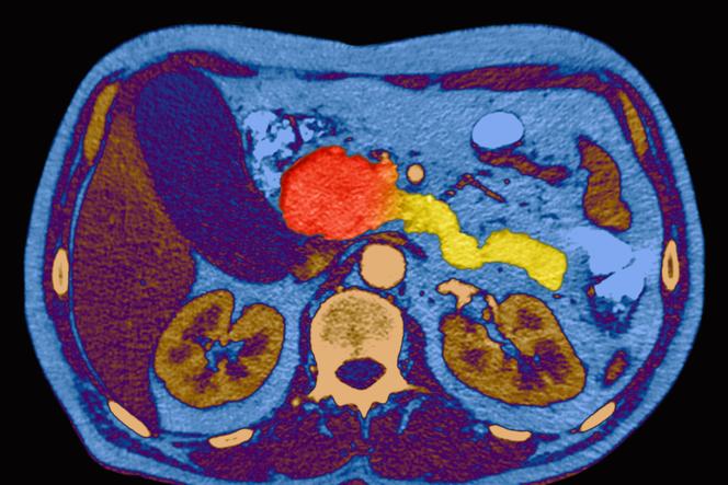 Tumor da cabeça do pâncreas visível no centro da imagem, em vermelho, em tomografia computadorizada colorida de abdome em corte axial.