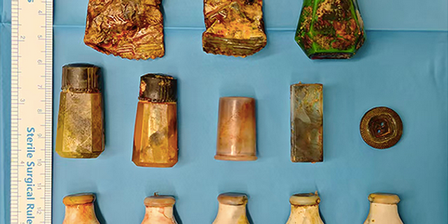 Treize corps étrangers retenus dans le vagin pendant plus de vingt ans