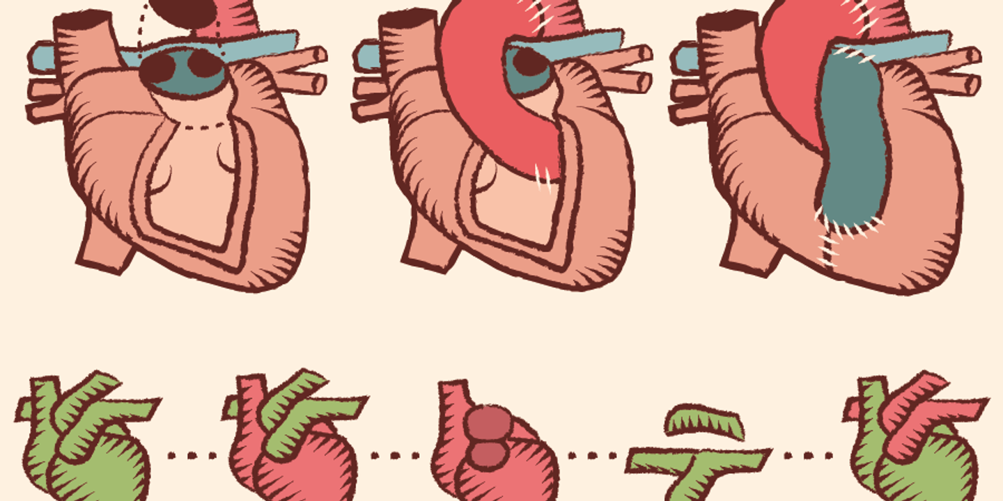 Transplantation cardiaque partielle : une révolution pour les très jeunes enfants