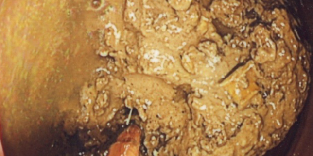 Constipation chronique : quand le Coca-Cola aide à dissoudre un fécalome géant
