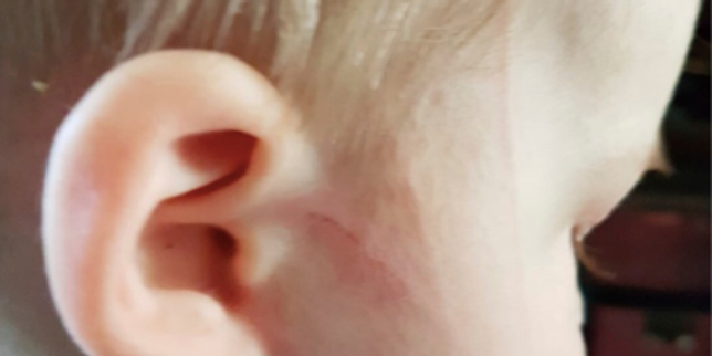 Grave épilepsie réfractaire chez un enfant : des années d’errance diagnostique après une simple griffure de chat