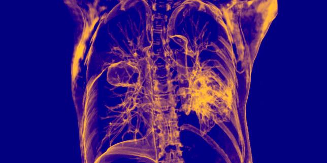 Cancers du poumon à petites cellules : une nouvelle immunothérapie permet un gain de survie « jamais vu »